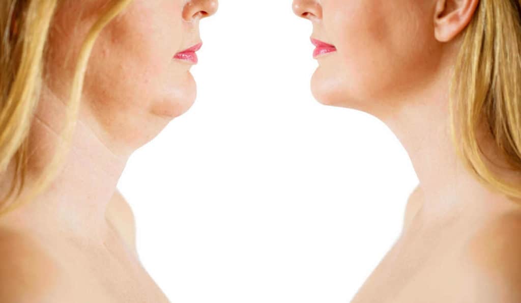 Double Chin treatment Bracknell before and after results