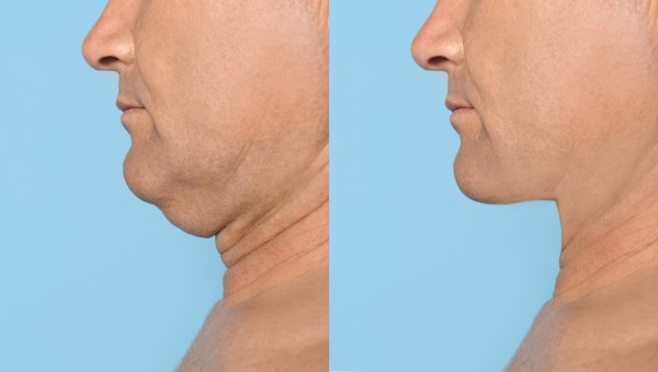 Which Non-Surgical Treatments Work Best for Jowls and Loose Skin Bracknell?