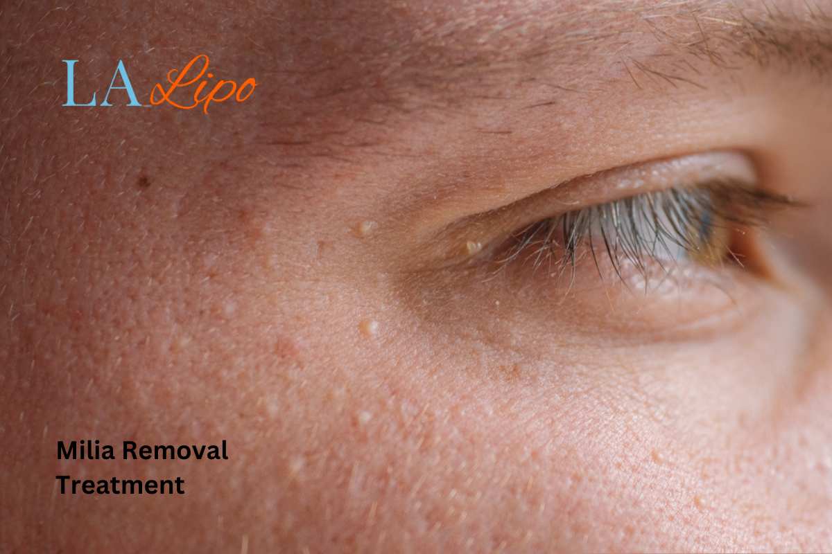 Cryopen Milia Removal: Is It the Easiest and Safest Option Bracknell?