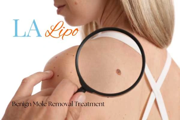 Woman having her inspection of blemish before mole removal Bracknell