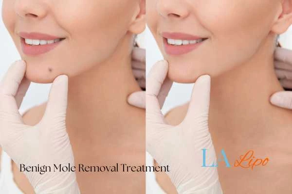 woman's before and after mole removal Bracknell results