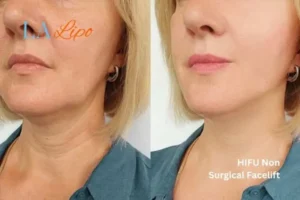 hi-fu for wrinkles Bracknell before and after results