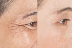 Before and after results of woman - HI-fu wrinkles reduction treatment Bracknell