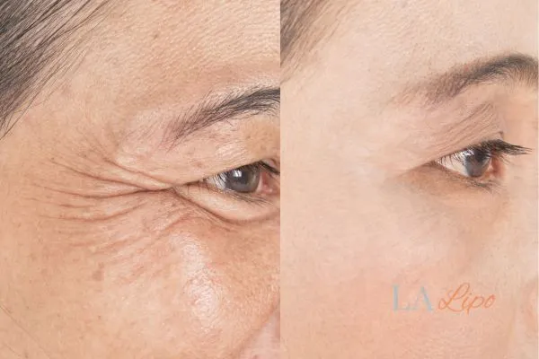 Before and after results of woman - HI-fu wrinkles reduction treatment Bracknell