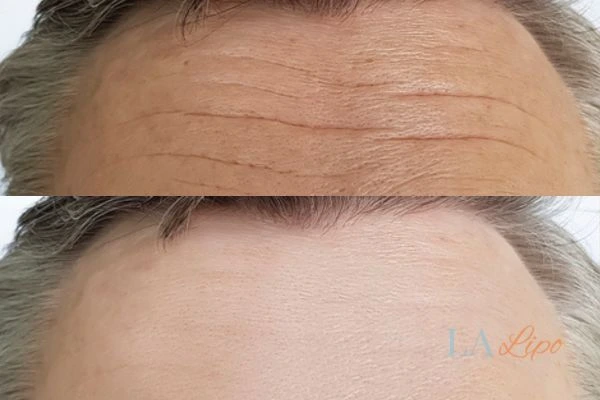 results of HIFU Bracknell on mans forehead to help reduce lines and wrinkles