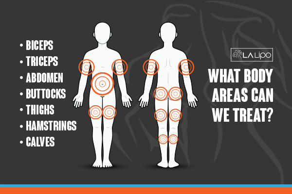 Graphic to show areas you can have LA-EMS Body Sculpting Bracknell treatment.