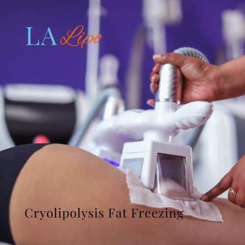 fat freezing - Cryolipolysis Bracknell