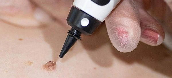 skin tag removal using cryopen Bracknell