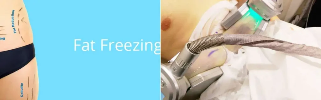 Fat freezing Bracknell on multiple areas of the body