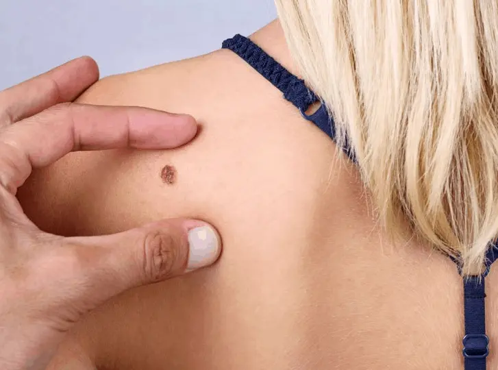 woman having mole removal Bracknell consultation before treatment.