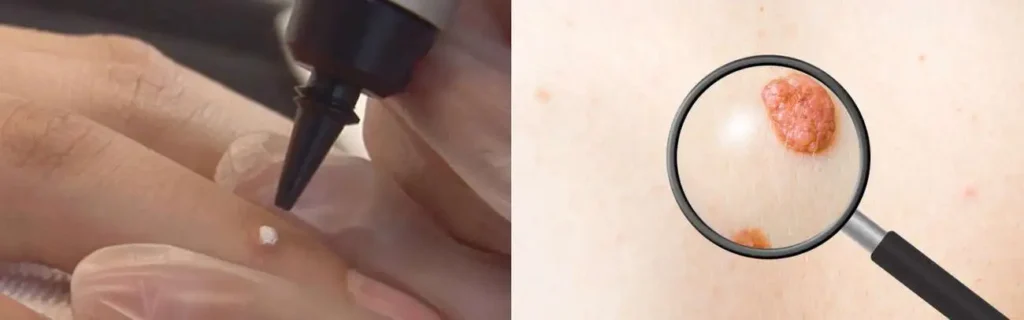 Cryopen for mole removal Bracknell - speak to our team today!