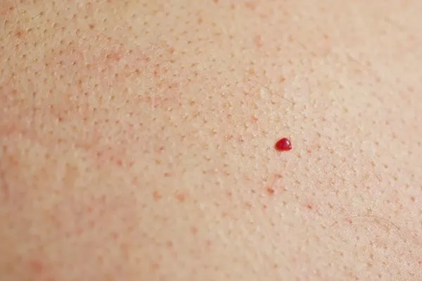 close up of a cherry angioma Bracknell