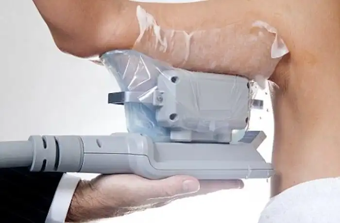 Picture of fat freezing Bracknell on the upper arms.
