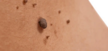 image of a skin tag Bracknell