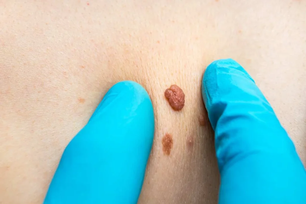 Consultant examining a skin tag Bracknell
