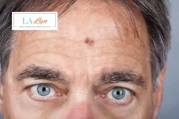 Solar Lentigo Removal Bracknell image of man with mark on his forehead