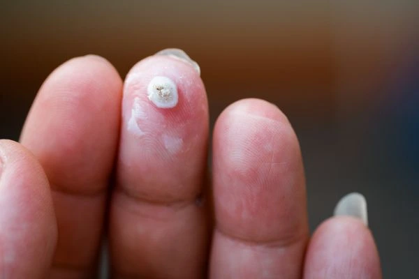 wart on person finger - cryotherapy to treat from LA LIPO Bracknell
