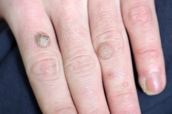 photo of warts on person hand - see wart removal Bracknell from LA LIPO