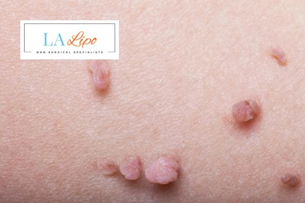 Does cryopen skin tag removal Bracknell hurt? Find out now call our team today!