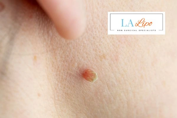 Book skin tag removal Bracknell today speak to our team now!