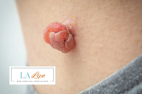 Interested in skin tag removal Bracknell? Concerned about the pain? Find out more today!