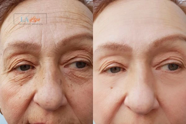 The powerful benefits of Morpheus8 Treatment Bracknell - Call Our team today!