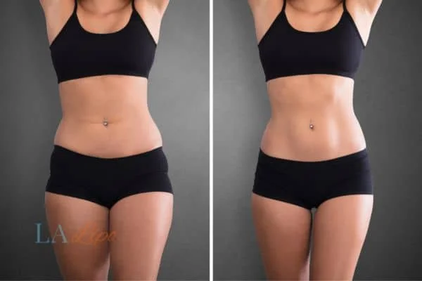 before and after results of non-surgical treatment to help a woman's body image and mental health Bracknell