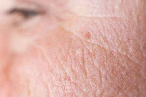 close up picture of a woman's face showing an age spot Bracknell