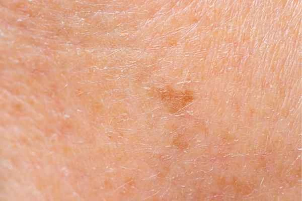 close up picture of age spots Bracknell