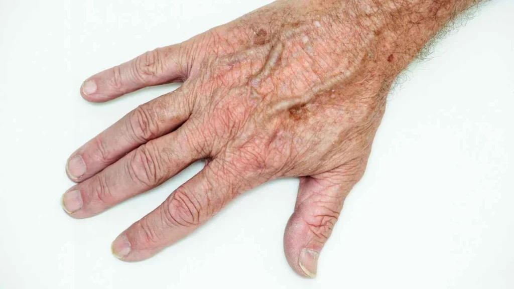 Male hand showing age spot Bracknell