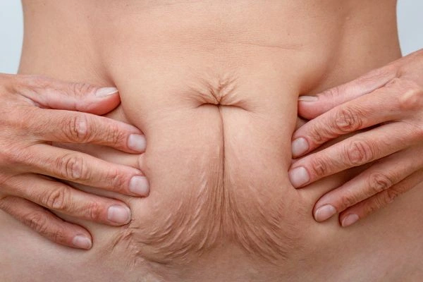 Image of a woman's stomach with loose skin - example of skin tightening Bracknell options