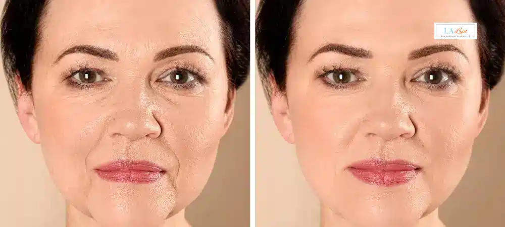 How Long Does It Take to See Results and How Long Do They Last Bracknell?