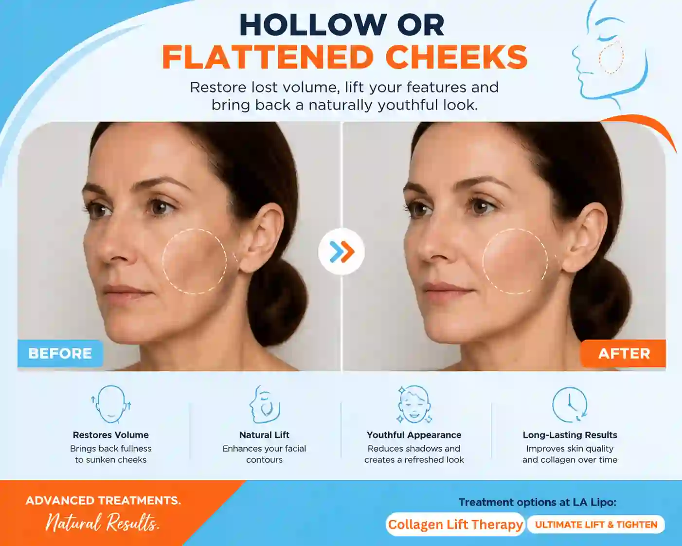 Sign #4: Hollow or Flattened Cheeks Bracknell