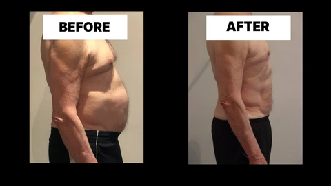 What Symptoms Can Diastasis Recti Cause in Men? Weak Core, Back Pain and Poor Posture Bracknell